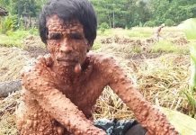 Penuh Benjolan di Sekujur Tubuh