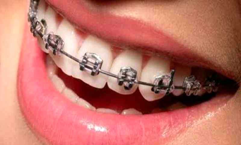 Ini Fungsinya Karet Behel Diganti Rutin Balipost Com