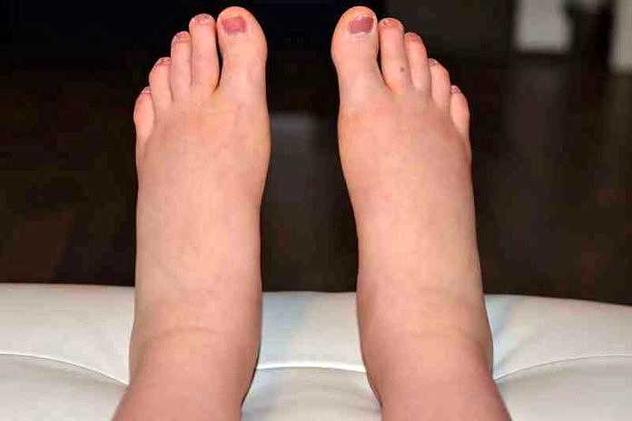 Kaki Bengkak