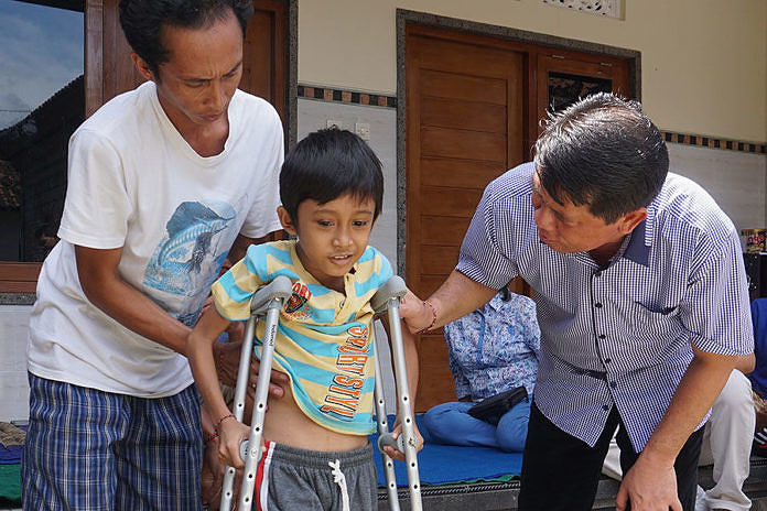 Kehilangan Kaki Pasca Kecelakaan Bupati Suwirta Bangun Semangat Hidup