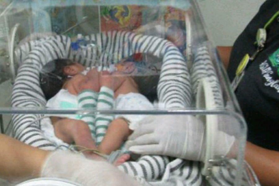 Bayi Kembar Dempet, Saat Operasi Sesar Baru Ketahuan 