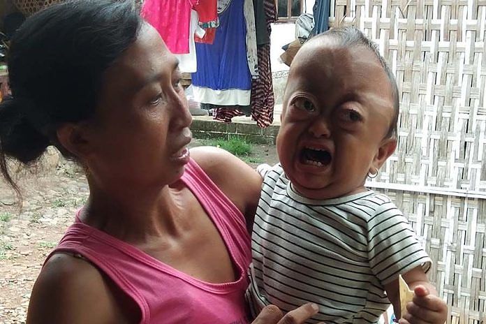 Derita Anggraini, Balita Alami Kelainan Tempurung Kepala 1