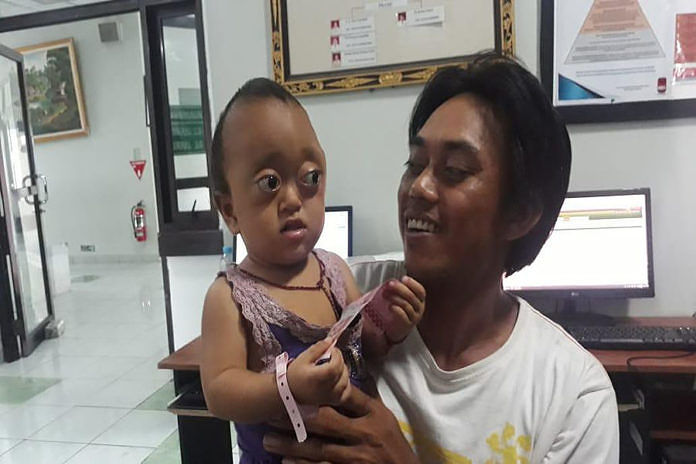 RSUP Sanglah Terima Pasien Crouzon Syndrom, Kasus Langka dan Pertama Kali Ditangani 1