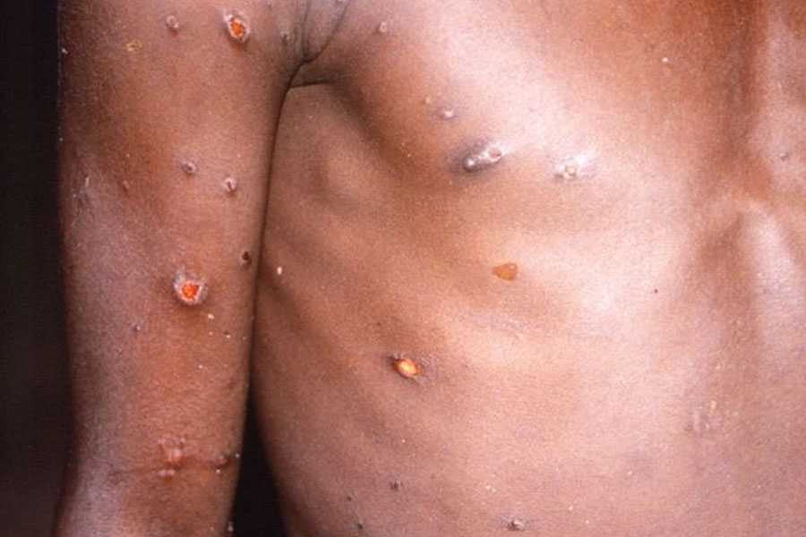 Two cases of monkeypox infection discovered in Canada