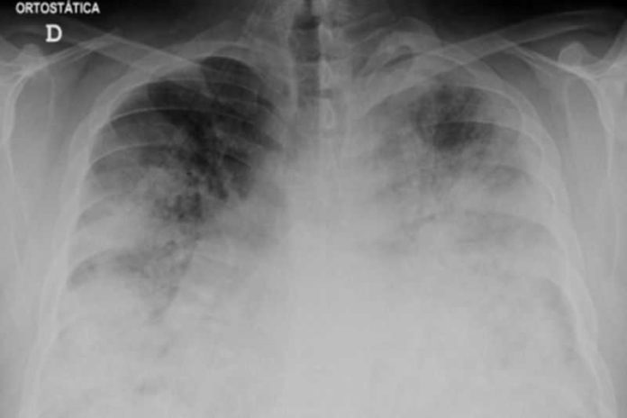 Kematian Akibat Penyakit Legionnaires Alami Kenaikan Di Polandia 1