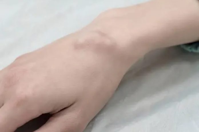 Lipoma, Ini 5 Cara Mengurangi Risikonya! 1